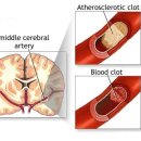 뇌졸중 막으려면 ´10계명 지켜라 이미지