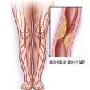 “걷는 것도, 서있는 것도 힘들다구요?” 다리 아픈 원인이 심장 탓일 수 있다 이미지