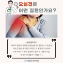 오십견의 원인과 비수술적 치료 이미지