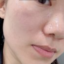 NO.1 자동차피부과 | 피부 리셋을 위한 강남 피부과 블룸 쥬베룩 스킨부스터 시술 후기