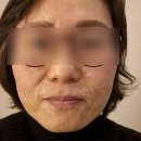 장덕한방병원 | 장덕한방병원 서초점 팔자주름 채우는 시술 쥬브젠 내돈내산 후기 (사실 엄돈엄산임^^)