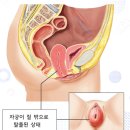 자궁내려옴으로 가장 많이 받았던 질문 2가지