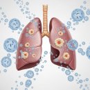 결핵 초기증상과 원인, 격리 필요성과 폐결핵 전염 위험성 이미지