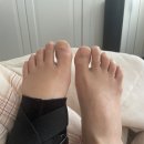 용우상사 | 전거비인대 파열+견열골절 3-4주차 비수술치료 일기