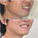 호두 치과의원 | 유학생 돌출입 인비절라인 발치 교정 입술부전증 호두턱 자갈턱 반대교합 치료기간 2년 8개월 재제작...