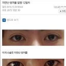 쌍꺼풀 없애는 수술한 디씨인 이미지