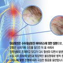 대상포진 통증 알고 봤더니 이미지