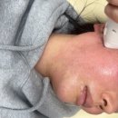 세이멍 | 영종도피부과 써니리프팅 덕에 턱라인이 생겼어요 두피 아픔 멍 후기