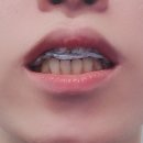 디메디 | 수면 중 이갈이 방지하는 방법 (디메디코리아 실제 후기)