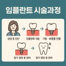 임플란트 시술과정, 실제로 어떻게 진행될까?