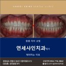 창원교정치과 MTA 교정 장치를 이용한 급속 부분 교정 치료 후기