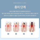 봉은사역 충치치료 치과 충치 단계 확인 후 진료