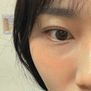 천안시청 필러 추천 💉 엘츠의원 앞볼 필러 후기 &amp; 가격 총정리!