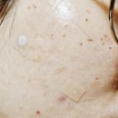 청담유의원 | 사마귀 레이저 치료 일기 1 / 병원별 가격, 관리 및 세안 방법 / 미친 듯이 간지러움
