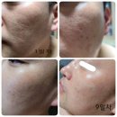 인셀덤 서초뷰티 | [공지] [인셀덤부작용] 실제사용한 후기!!