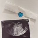 강남 애플 산부인과 아기집 보고 온 날 후기 (임신 5w 2d)
