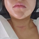 로글로 | 갑상선암 수술 5년 차 후기 : 정기검진, 산정특례, 전이 경험까지 솔직히 공개!
