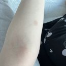 독한고양이 | 고양이 링웜 사람 치료 후기, 사용한 연고는 무엇?