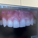 라인에 미치다 | 신사역 치과 :: 무삭제 라미네이트 내돈내산 발품 후기! 앞니 라미네이트 비용/가격/후기 (1)