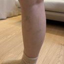 대복의원 | 하지정맥류 수술 진단, 하지정맥류 초음파 검사 후기(1)