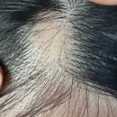 곤케어 | [ 청주 더 데이지 ] 20대 여성 원형탈모가 받은 청주 두피관리 청주 두피케어 솔직후기