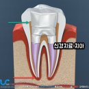 바다치과기공소 | 앞니 지르코니아 재신경치료 치관확장술 하는 이유