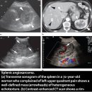 Splenic angiosarcoma 이미지