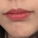 Ray_o | 거미스마일, 잇몸돌출 치아교정 후기(발치O)