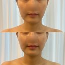 백석로 | [의정부] 회룡역리프팅관리 가꾸는동안&amp;숲칼프 의정부교육센터 1회관리로 달라진 후기