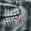 초계치과의원 | 매복 사랑니 발치 후기 (feat. 주의사항, 음식, 양치 등등..)