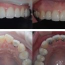 [설픅교정,부분교정,치아교정 잘 하는 치과]신촌연치과 "작은 설측장치를 이용한 부분교정" 이미지