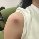 로벤의원 | 대구 어깨 피지낭종 제거 외과 수술 받은 후기 (비용, 실비)