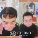 화정ㆍ행신ㆍ원당 넓은 이마·M자 이마 고민 끝｜헤어라인 이벤트 3회 55만원 후기