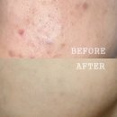 건제약국 | 여드름 흉터 재생크림 연고 레이저 고민되는 사람?!