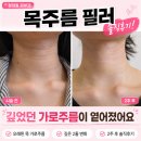 본투비뷰티 | 목주름필러 후기 깊은 가로주름 서브시전 통증 멍 솔직 기록