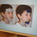 예쁜얼굴 바른이 치과의원 | 6세 반대교합 교정 후기, 프리올소(Pre-Ortho) 3주 만에 나타난 놀라운 변화 (비용 및 시기 팁)