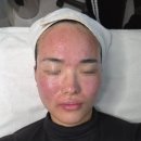 쎄니떼뷰티샵문화3호점 | 속건조 좁쌀여드름 MTS 필링 솔직 후기 | 안양범계피부관리 디또뷰티안양범계점 (구)유리나스킨 4회차