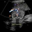제일중기 | [22주] 동탄제일병원 중기 정밀 초음파 후기