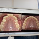 더원치과교정과치과의원 | 구리 더원교정치과 교정 후기 (+교정 전후 사진 有)