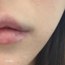 광장로4번길 | 부평역 피부과 입술필러 잘하는 곳 ㅇㄹㅅ클리닉 솔직후기