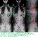 척추분리증과 측만증이 함께 있던 환자의 치료사례 이미지