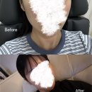 바노바기의원 | 바노바기의원 창원 인모드 FX 솔직 후기