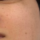 콜드플라즈마 후기 통증 다운타임 뷰티온화 대구 피부관리