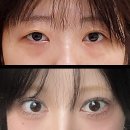 치유성형외과의원 | 자연유착 + 눈매교정 치유에서 하길 잘했어! (쌍꺼풀수술)