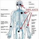 신체의 임플란트의 영향 이미지