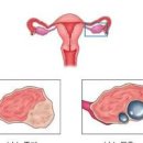 난소 물혹 증상 및 원인과 수술 : 터짐 통증 임신 난소 혹(낭종 종양) 이미지