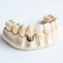 서울탑치과병원 | 서초 임플란트 잘하는곳, 부작용까지 잡아내는 유명한 치과. (Ft. 서울탑치과병원)