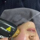 홍대/홍대입구역 피부과 티타늄리프팅 솔직 1회차 후기 [B&amp;A]