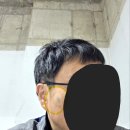 서울대입구예쁨주의쁨의원 | 신논현/강남 피부과 리팟레이저/흑자레이저 [ 예쁨주의 쁨의원 강남본점 ] 얼굴 흑자 제거 REAL 후기
