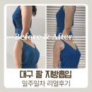 택이유통 | 대구 팔뚝살 빼는 팔 지방흡입 수술 병원 택부터 수술당일 ~ 일주일차 변화 후기:)